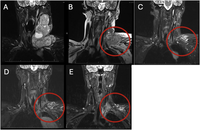 Use of PULSAR (personalized ultra-fractionated stereotactic adaptive radiotherapy) as consolidation with immune checkpoint inhibition in the treatment of pediatric metastatic melanoma.