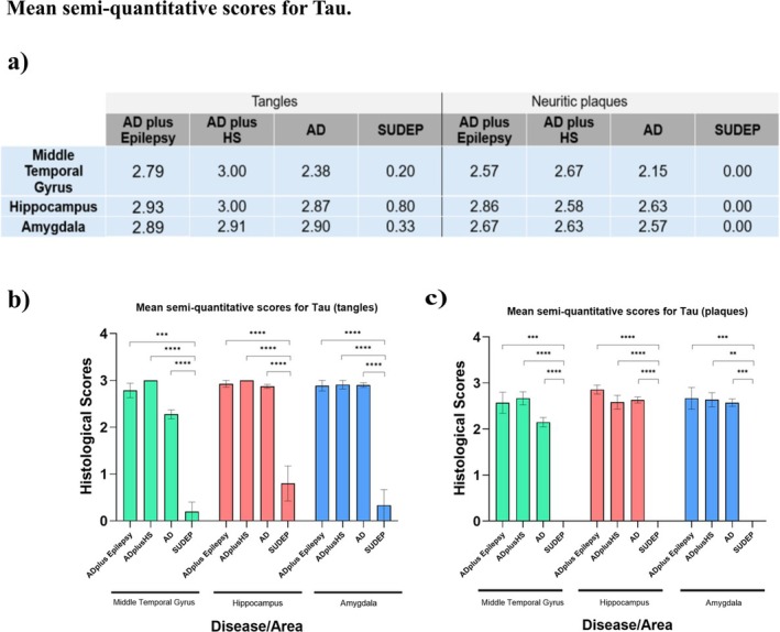 Increased Incidence of Epilepsy in a Brain Bank Alzheimer's Disease Cohort and Its Association With TDP-43 Pathology.