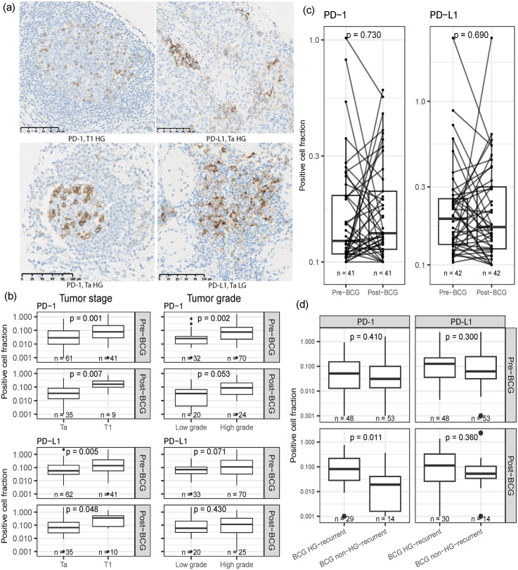 Expression of PD-1 and PD-L1 in BCG-treated NMIBC.