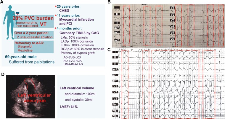 Case report of ventricular tachycardia simulation facilitated ablation for refractory ventricular arrhythmia post-myocardial infarction: aiming before firing.