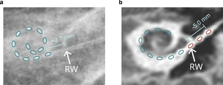 Impedance-based detection of cochlear implant array migration: case report in a child with Aymé-Gripp syndrome.