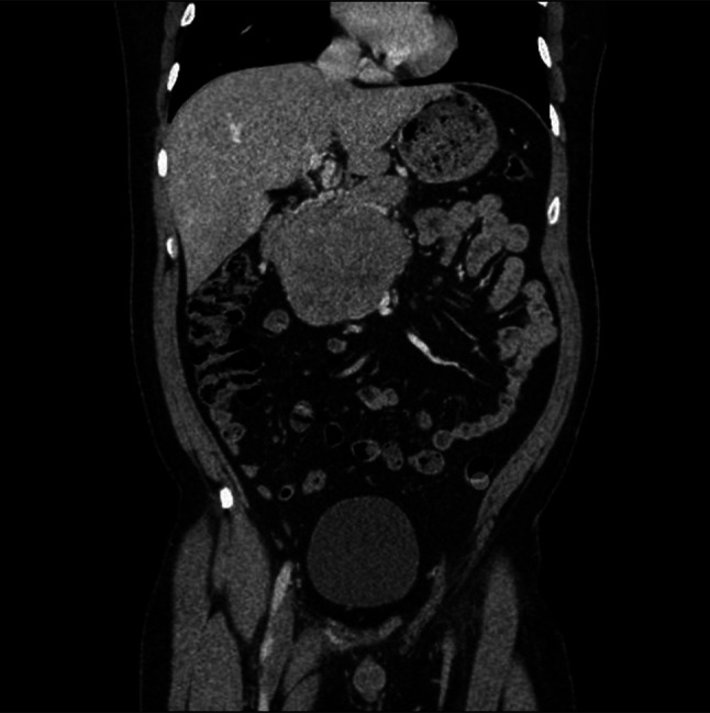 Adult-Onset Pancreatoblastoma.