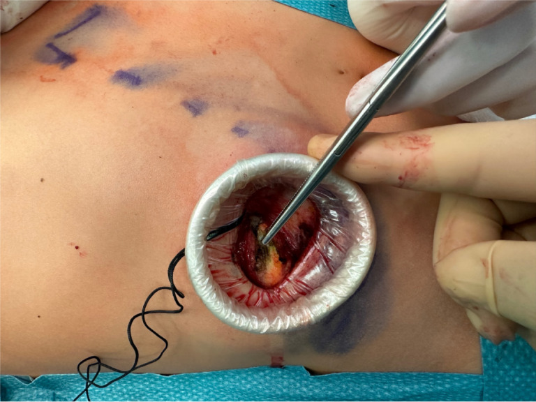 Minimally invasive surgical approach for slipping rib syndrome: A case report.