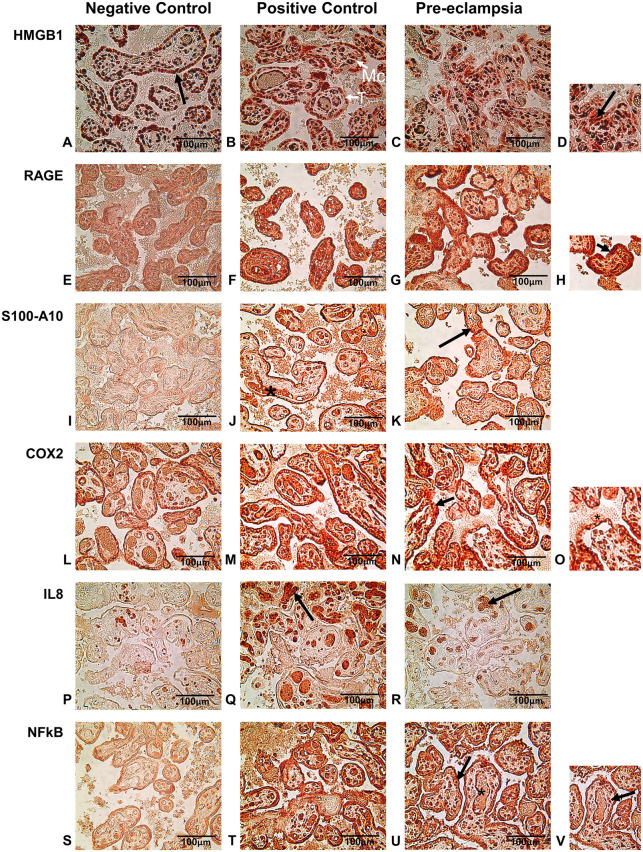Inflammatory mediators and the RAGE pathway in placental tissues of pregnancies complicated by severe preeclampsia.