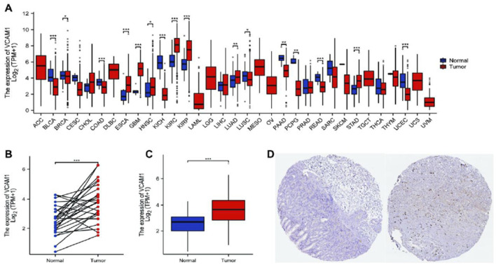 <i>VCAM-1</i> predicts poor prognosis and modulates immune infiltration in gastric cancer: a TCGA-based bioinformatics study.