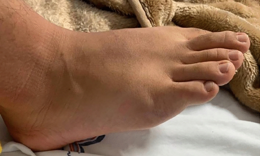 Presentation of osteoid osteoma in the fifth metatarsal: a case report and review of the literature.