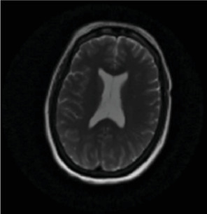 Delayed Posthypoxic Leukoencephalopathy in a Catatonic-Appearing Patient: A Case Report.