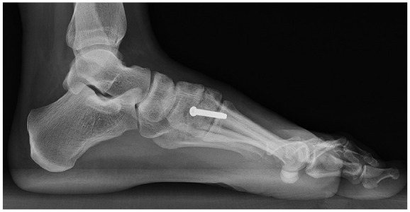 Clinical Outcomes after ORIF vs Arthrodesis for Subtle Lisfranc Injuries: A Minimum 2-Year Comparative Study.