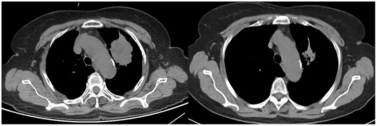 Effectiveness and Safety of Anlotinib-Related Therapeutic Regimens in Patients with Previously Immune Checkpoint Inhibitors-Treated Advanced NSCLC: A Real-World Exploratory Study.