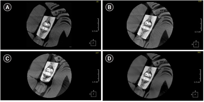 How protocol, posts, and experience affect fracture detection in multi-rooted teeth using cone-beam computed tomography: an ex vivo experimental study.