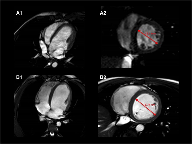 Clockwise bundle branch re-entrant ventricular tachycardia in a teenage patient as the first manifestation of dilated cardiomyopathy associated with the p.Ile512Leu TNNI3k variant: a case report.