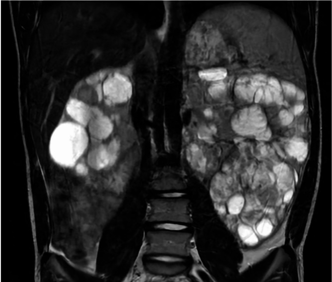 Bilateral, multicystic fumarate hydratase-deficient renal cell carcinoma in patient with hereditary leiomyomatosis & renal cell carcinoma syndrome: A case report and review of the literature.