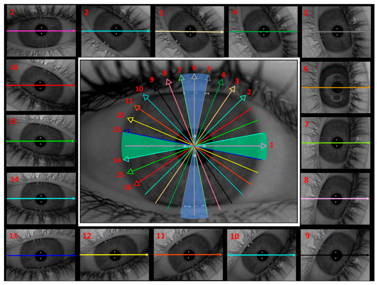 A Novel Method for Analysing the Curvature of the Anterior Lens: Multi-Radial Scheimpflug Imaging and Custom Conic Fitting Algorithm.