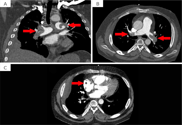 Catheter-Based Thrombectomy for Clot-In-Transit and Massive Pulmonary Embolism In A Young Patient with Rheumatoid Arthritis: Inflammation as A Hidden Catalyst for Catastrophic Thromboembolism.