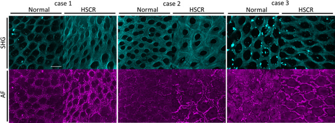 Label-free diagnostic procedure for hirschsprung's disease to detect intestinal mucosal characteristics of aganglionosis by Raman spectroscopy with optimized decision algorithms.