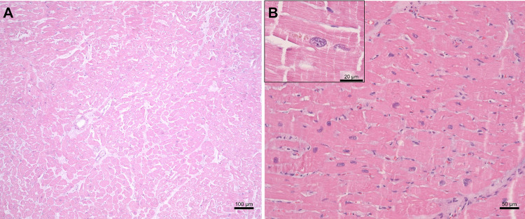 Acute myocardial infarction in a young patient with Chikungunya: a case report.