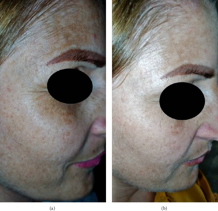 Low-Level Laser Therapy as an Effective Intervention for Facial Pigmentation: A Case Report of Ephelides and Lentigines in Syrian Women.