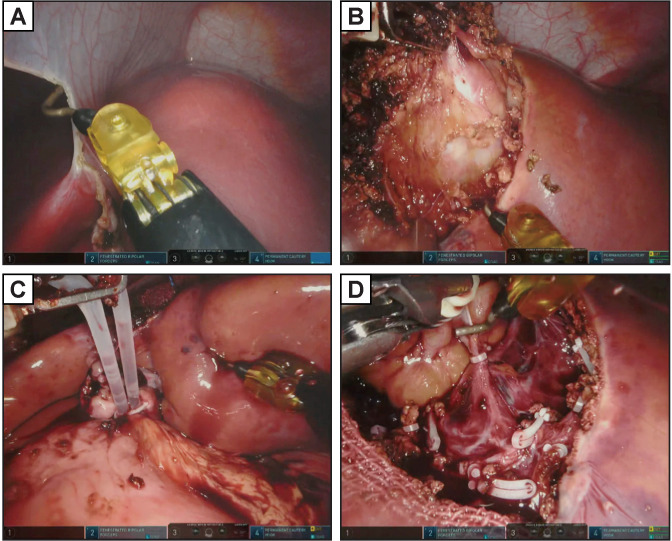 Robotic liver resection for hepatic focal nodular hyperplasia in children: comparison with open surgery.