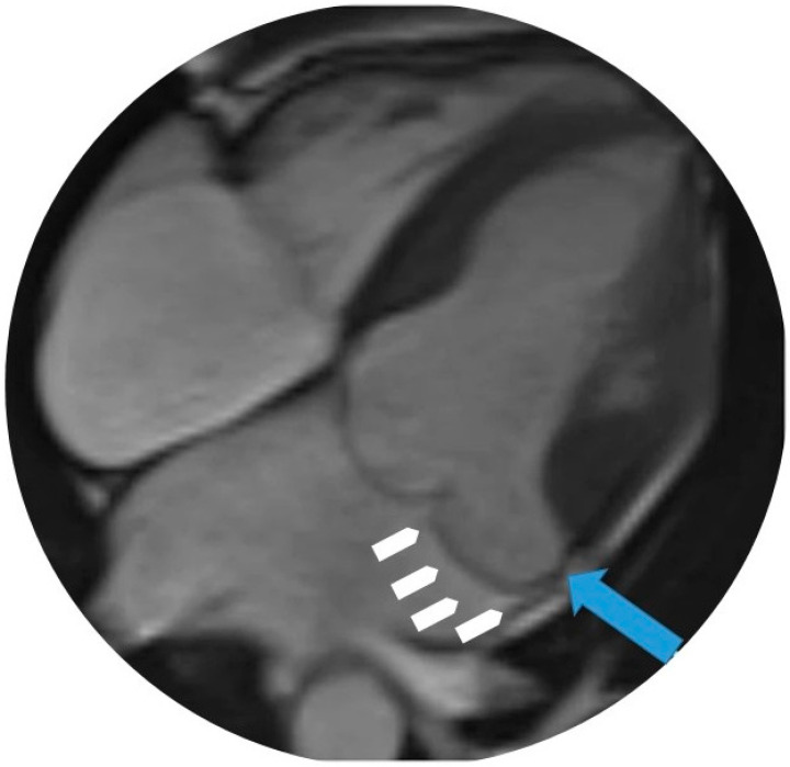 Mitral Annular Disjunction: Epidemiology, Diagnostic Methods, Prognosis, and Novel Implications.