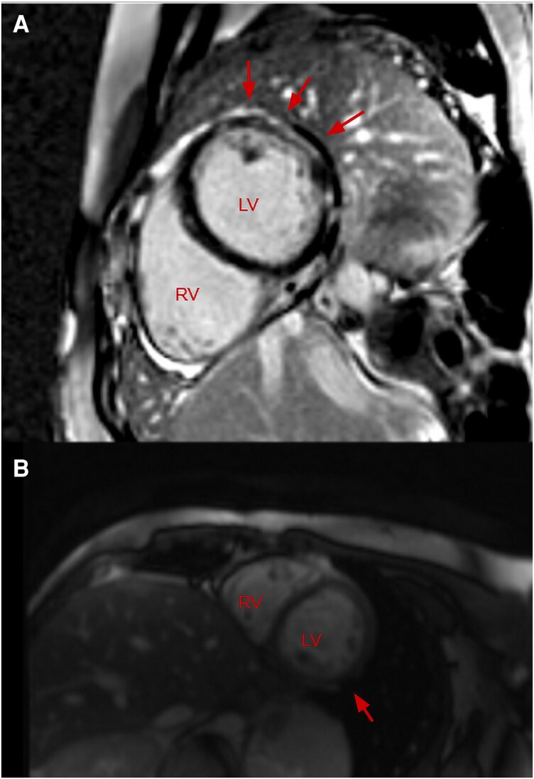 A reconsidered diagnosis in an unresolving myocarditis-a case report.