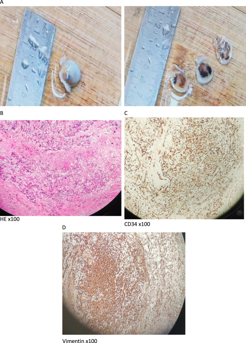 A comorbidity of cardiac atherosclerotic disease with cardiac myxomas being concomitantly treated by coronary artery bypass grafting coupling with tumor resection: a case report.