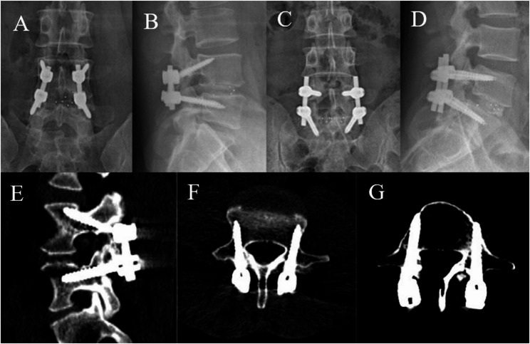 Comparative study of modified midline lumbar interbody fusion and modified transforaminal lumbar interbody fusion for the treatment of single-level lumbar degenerative diseases.
