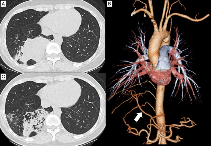 A Case of Hybrid of Congenital Pulmonary Airway Malformation and Anomalous Systemic Blood Supply Presenting Elevated Serum Levels of Carbohydrate Antigen 19-9.