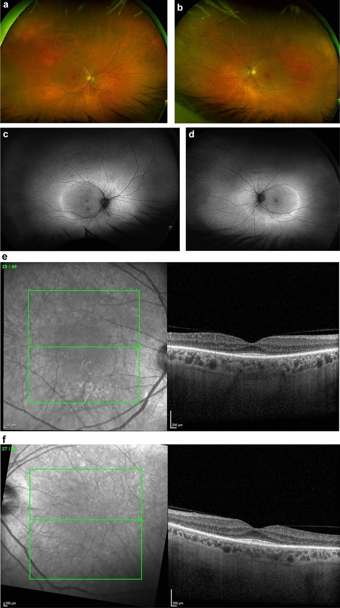 Diagnosis and treatment of autoimmune retinopathy: review of current approaches.