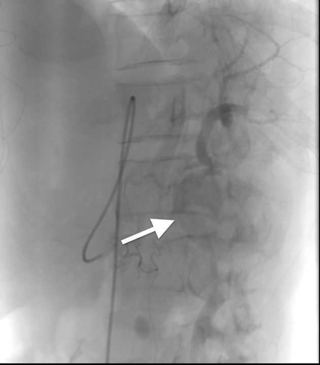Delayed Giant Splenic Artery Aneurysm Following Splenic Infarction in a Patient with Infective Endocarditis.