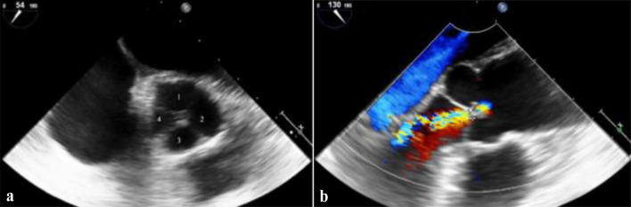 Thinking Outside the Box: Case Report of a Rare Quadricuspid Aortic Valve as an Underrecognized Cause of Heart Failure and Atrial Fibrillation.