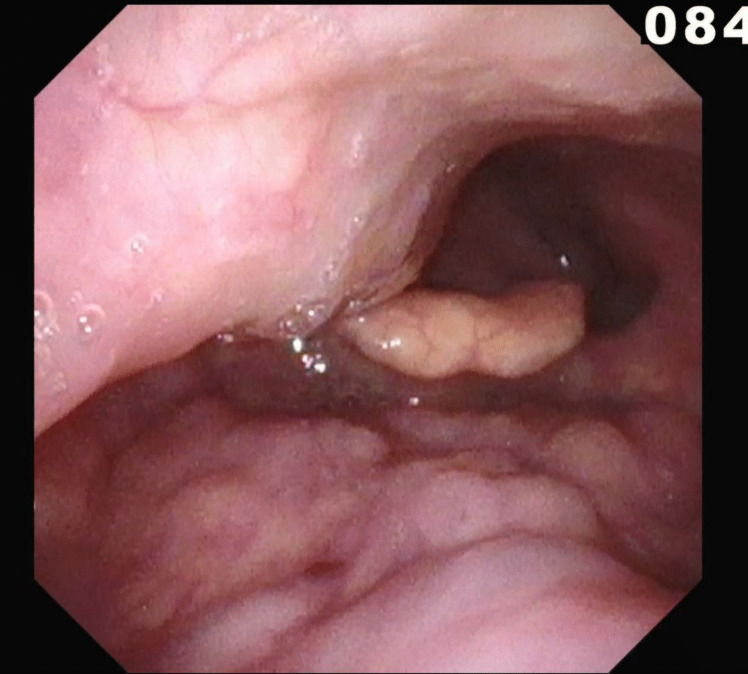Dysphagia from an aberrant internal carotid artery: a case report.