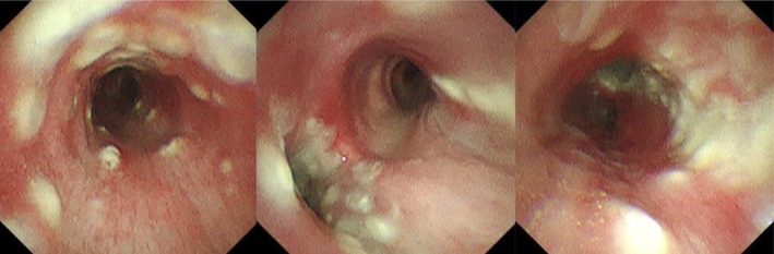 Tracheobronchial Tuberculosis During Treatment for Bronchial Asthma.
