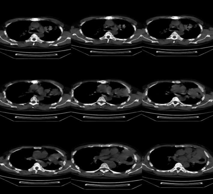 Rare Case Report of Pulmonary Mucosa-Associated Lymphoid Tissue Lymphoma.