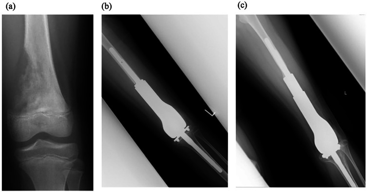 Long-term functional and quality of life outcomes after cementless minimally invasive extendable endoprosthesis replacement in skeletally immature patients with bone sarcomas at the lower limb : a Japanese Musculoskeletal Oncology Group (JMOG) study.