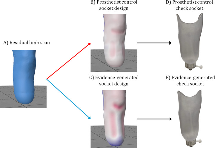 Evidence-Generated Sockets for Transtibial Prosthetic Limbs Compared With Conventional Computer-Aided Designs: A Multiple-Methods Study From the Patient's Perspective.