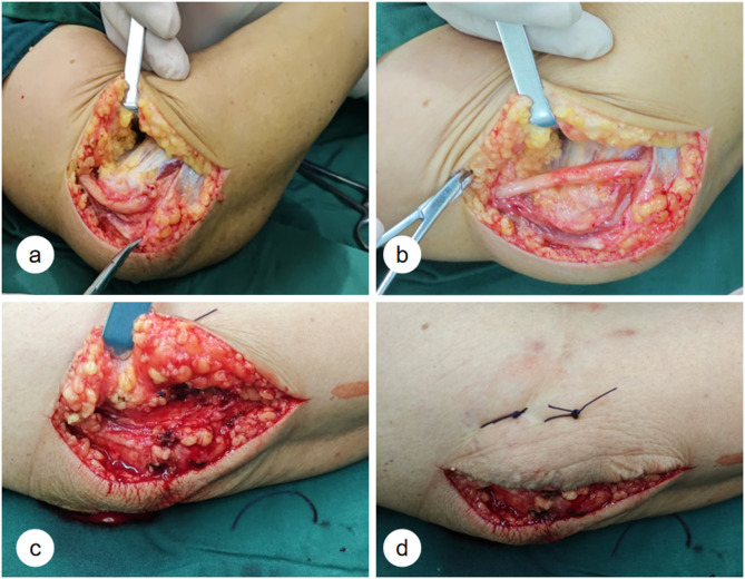 Short-term outcomes of percutaneous versus subcutaneous fascial flap fixation in cubital tunnel syndrome surgery: A retrospective cohort study.