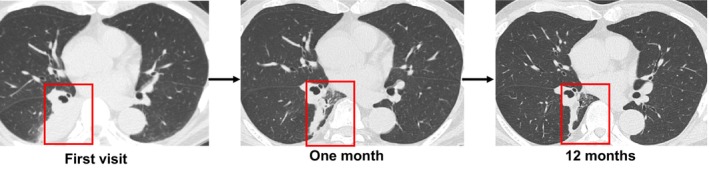 Endobronchial Lipoma Treated With Endoscopic Microwave Coagulation to Relieve Atelectasis: The First Case Report.