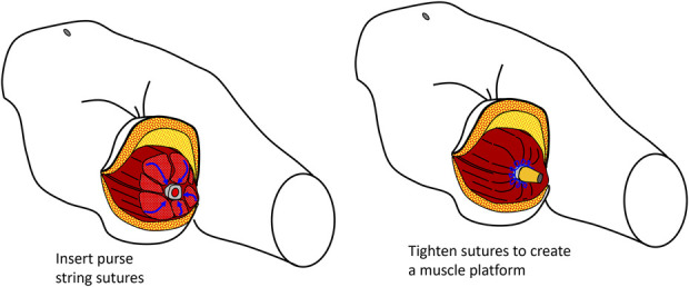 Use of a "Fascial-Sock" Technique to Manage the Stump and Stoma After Insertion of an Osseointegrated Implant in Transfemoral Amputees.