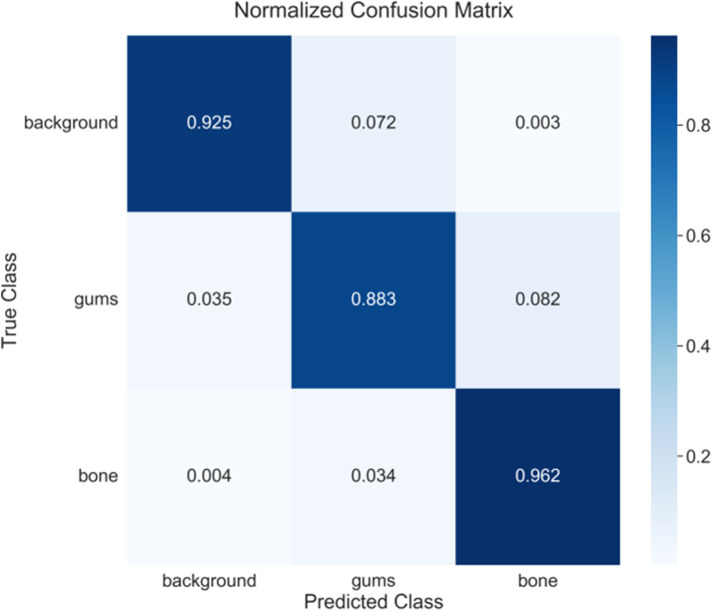 Clinical-oriented 3D visualization and quantitative analysis of gingival thickness using convolutional neural networks and CBCT.