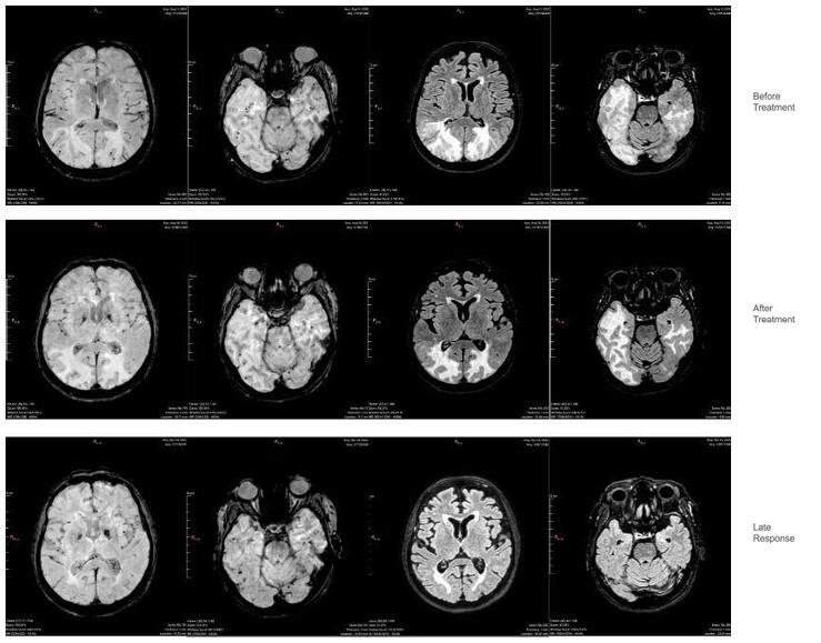 Cerebral inflammatory amyloid angiopathy: response to treatment.