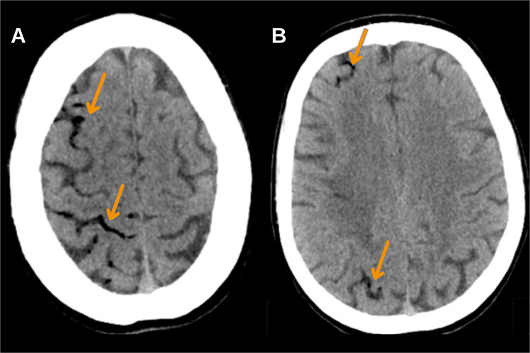 Radiological Findings of Retrograde Venous Cerebral Air Embolism Infarcts: A Case Report and Literature Review.