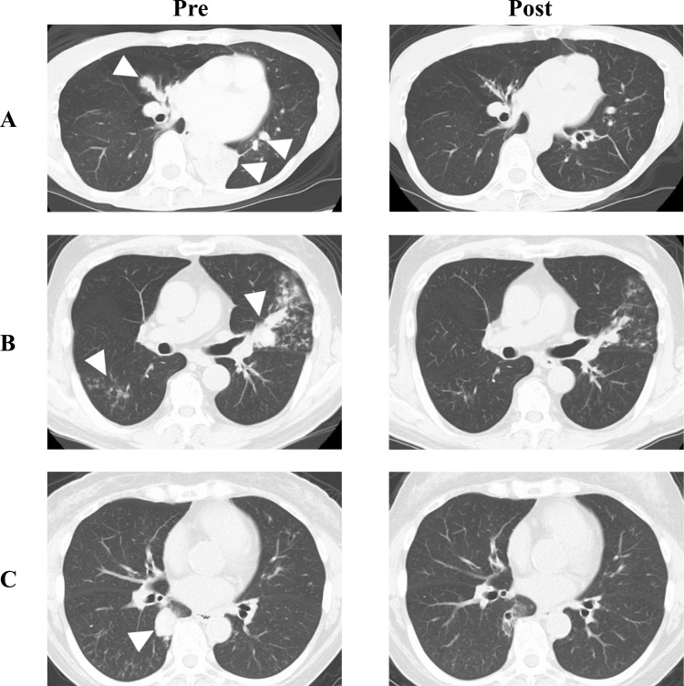 Three Biologic-Naïve Patients with Allergic Bronchopulmonary Aspergillosis Showing Significant Clinical Improvement with Tezepelumab.