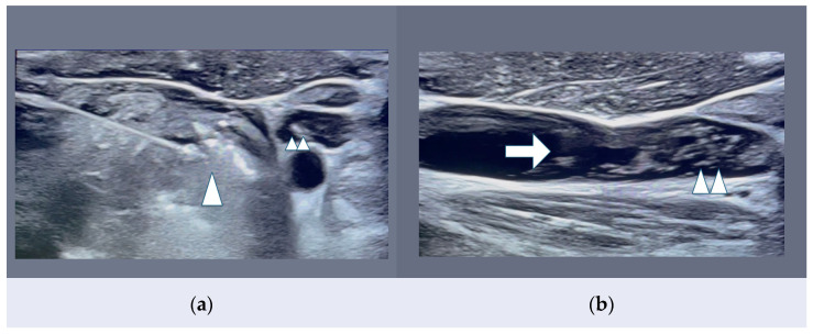 New Trends in Thyroid Malignancy: Minimally Invasive Thermal Ablation Percutaneous Techniques for T1 Papillary Thyroid Carcinomas.