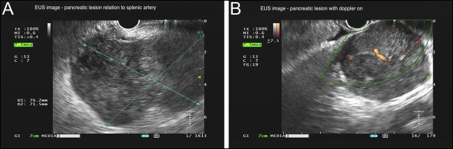 Pancreatic Metastasis From a Vulvar Melanoma Diagnosed by Endoscopic Ultrasound-Guided Fine-Needle Biopsy.