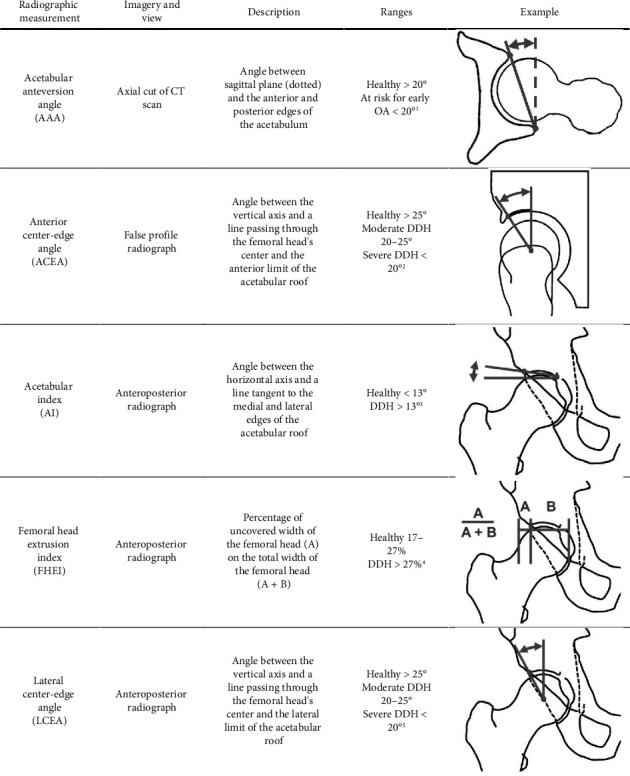 Multivariate Quantitative Outcomes of Periacetabular Osteotomy Using Discrete Element Analysis.