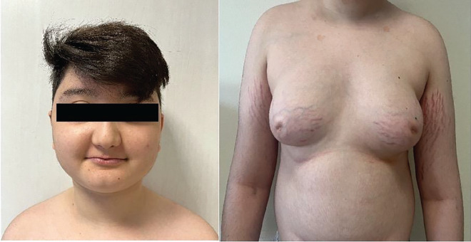 A Challenging Case of Ectopic Adrenocorticotropin Hormone Syndrome with Bronchial Carcinoid and Literature Review