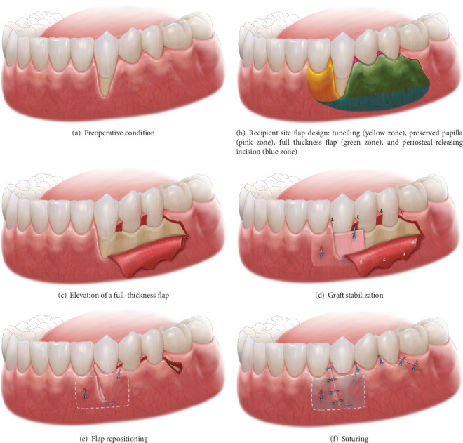 Modified Rotated Flap With Double-Component Releasing Incision and One-Sided Tunnel for Mandibular Gingival Recession: A Case Report.