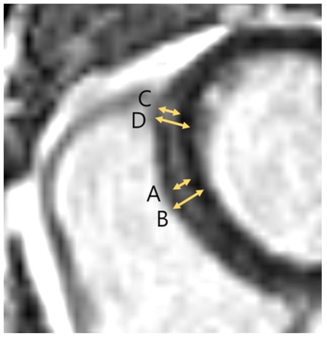 Late Gadolinium Enhancement Variation in Asymptomatic Individuals: Comparison with Dilated Cardiomyopathy.