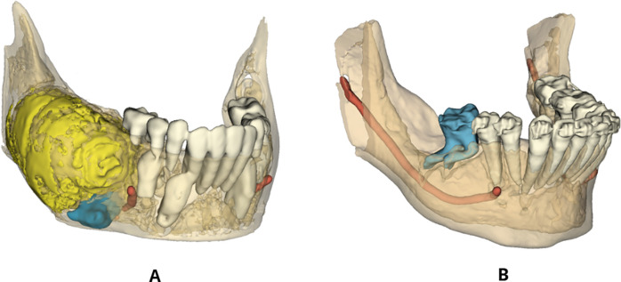 Influence of odontogenic lesions on root development in impacted teeth: a cohort study.