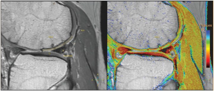 Autologous Osteochondral Transfer Demonstrates Satisfactory Clinical Outcomes and Durable Cartilage Properties: A Mean 4-Year Follow-up Using Quantitative MRI.